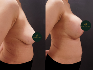 foto before after pasien(1) (Copy)