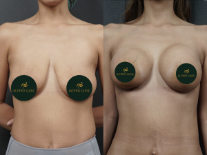 foto before after pasien(3) (Copy)