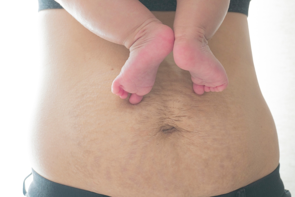 Woman's,Belly,With,Stretch,Marks,After,Childbirth,And,Her,Baby's