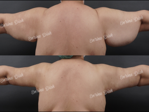 foto before after pasien