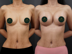 foto before after pasien (Copy)