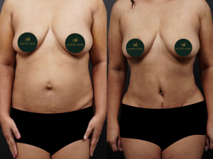 foto before after pasien (Copy)