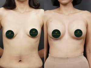 foto before after pasien (Copy)