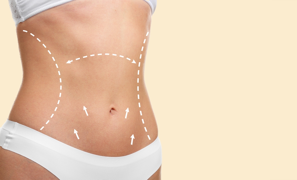 Tummy Tuck vs Sedot Lemak: Mana yang Tepat? | Ultimo Clinic